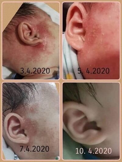 Shiruto relieve eczema on baby