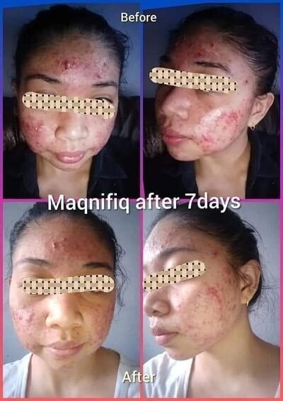 Maqnifiq acne relieve
