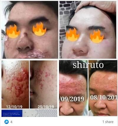 Shiruto acne testmonial
