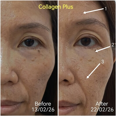Collagen Plus age spots lighten