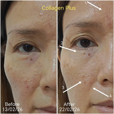 Collagen Plus results pores smaller