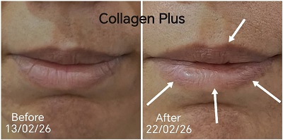 Collagen Plus less wrinkles on lips