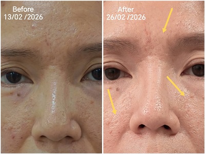 Differences in fine lines